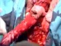 Sex change operation
