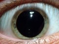 Eye