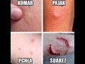 Jak rozpoznać co cię ugryzło
