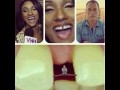 Diastema