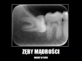 Zęby mądrości