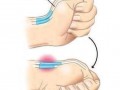 Tendon 