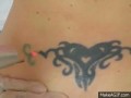 Usuwanie tatuażu